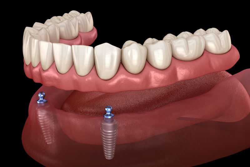 implant supported denture graphic