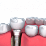 Medically accurate 3D illustration of a Dental Implant