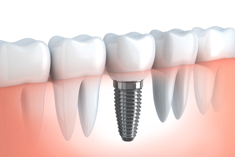 dental implant model.